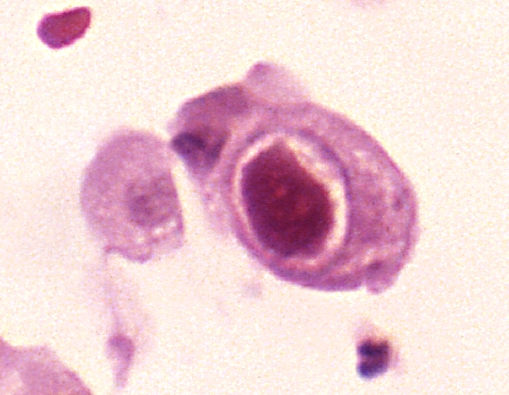 CMV-Infektion Lunge